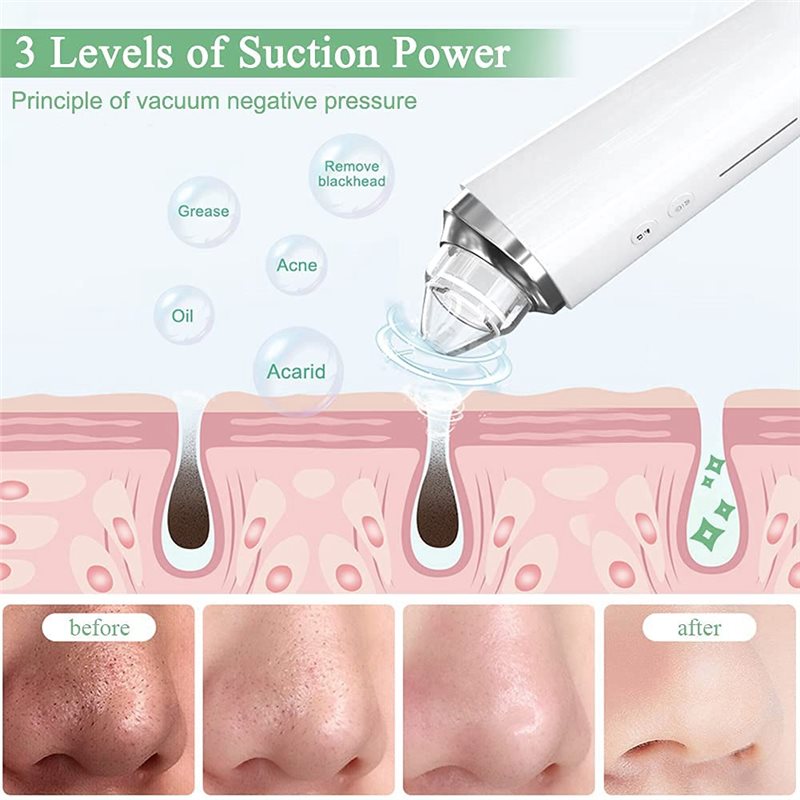 【FITTING】ชุดดูดสิวเสี้ยนพร้อมก - Pore Vacuum บทวิจารณ์และราคา