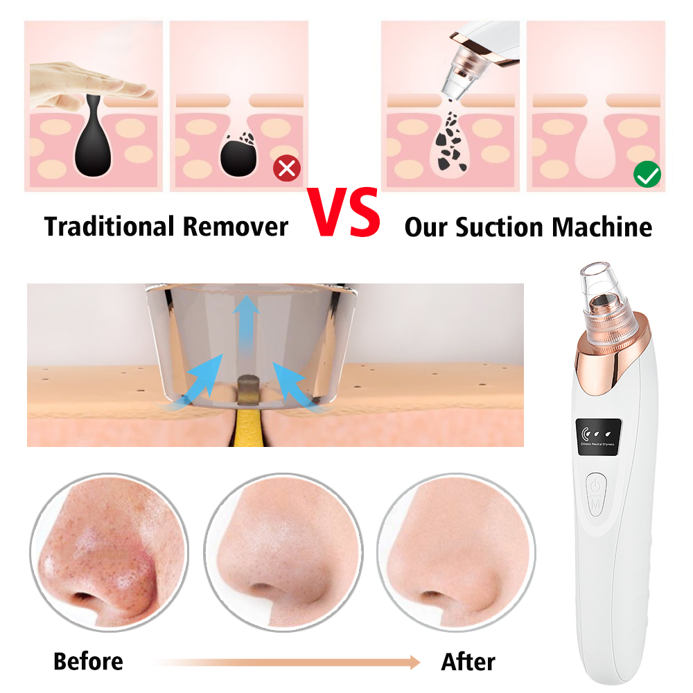 Blackhead Remover สูญญากาศ Por - Pore Vacuum บทวิจารณ์และราคา